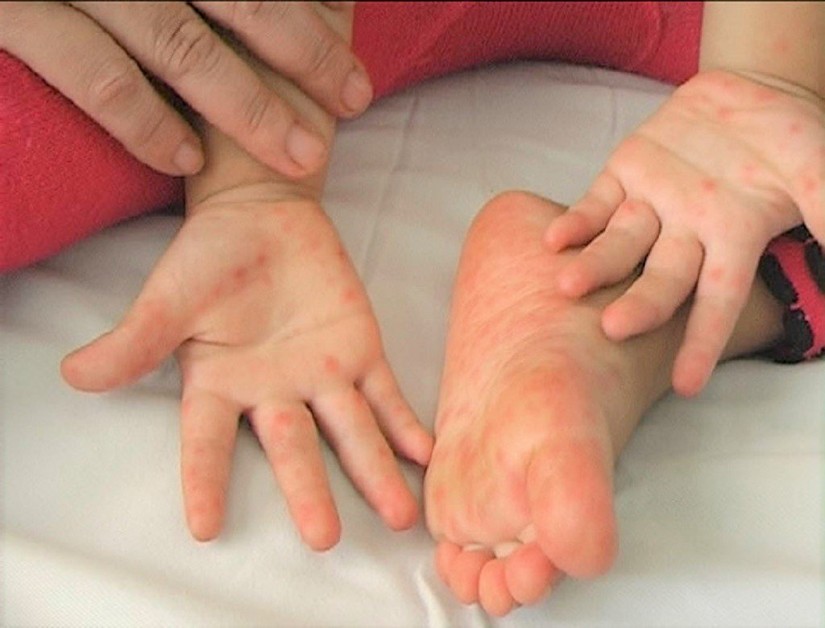 Số ca mắc tăng cao, Bộ Y tế y&ecirc;u cầu siết chặt ph&ograve;ng chống dịch tay ch&acirc;n miệng